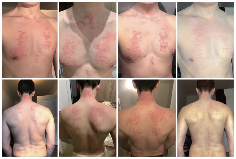 Keto Rash: